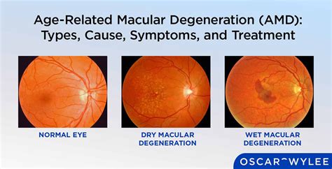 amd eye disease|Iba pa.